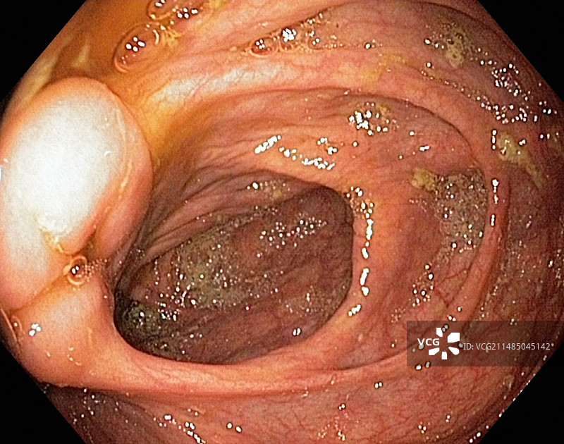 回盲瓣内窥镜视图图片素材