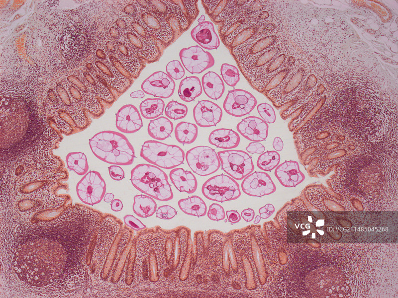 因蛲虫引起的阑尾炎，LM图片素材