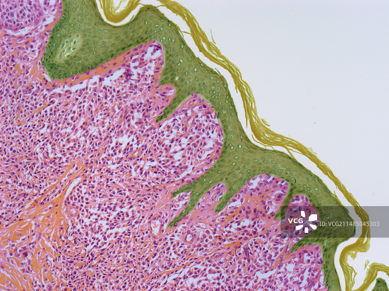 肥大细胞瘤显微照片图片素材