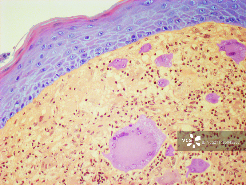 幼年黄色肉芽肿，LM图片素材