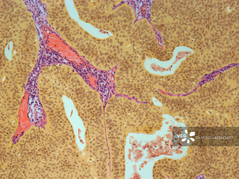 膀胱癌显微照片图片素材