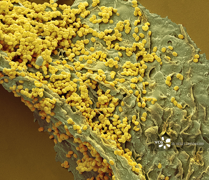 传染性软疣，扫描电镜图片素材