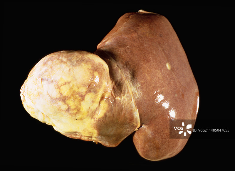 肝脏继发性癌症图片素材