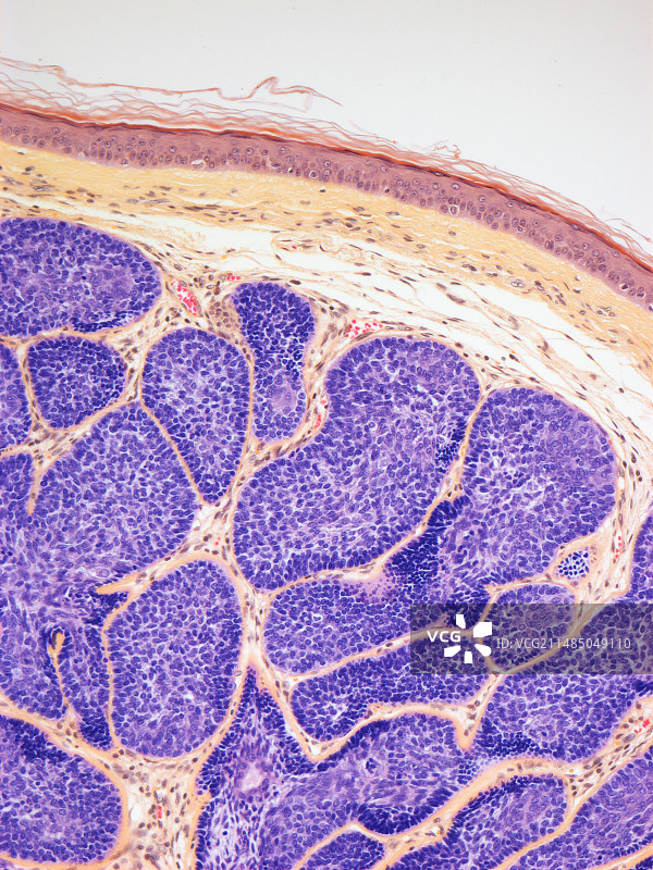 皮肤癌浅显显微照片图片素材