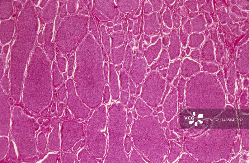 肠癌，光学显微照片图片素材