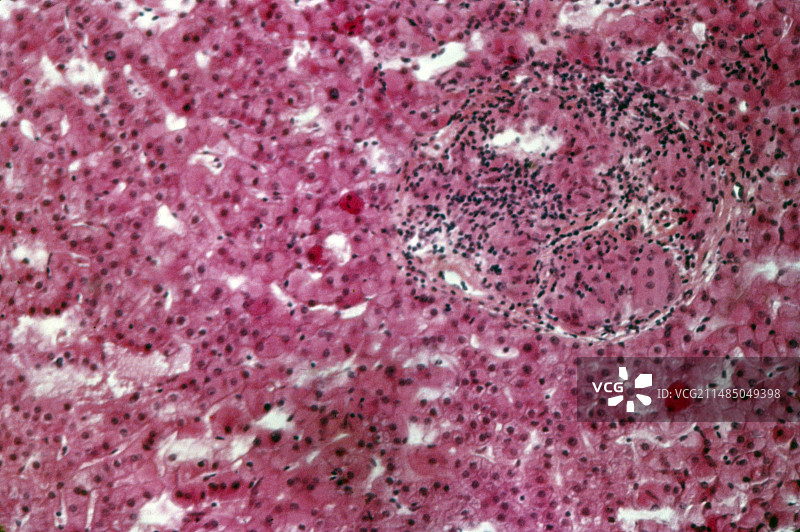 肝脏结节病，光学显微照片图片素材