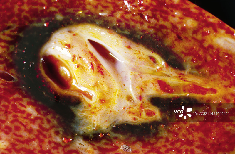 胆管炎症图片素材