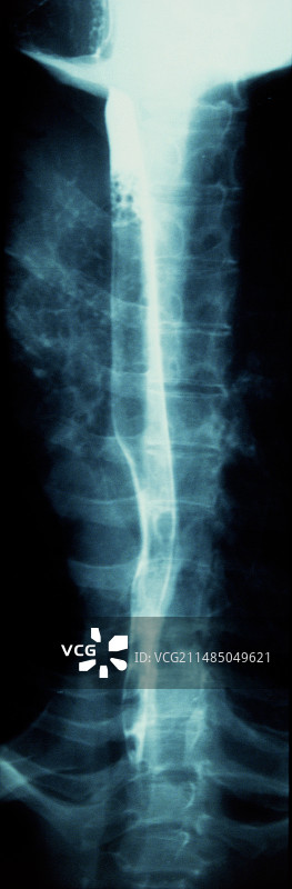 健康的食道，X光片图片素材