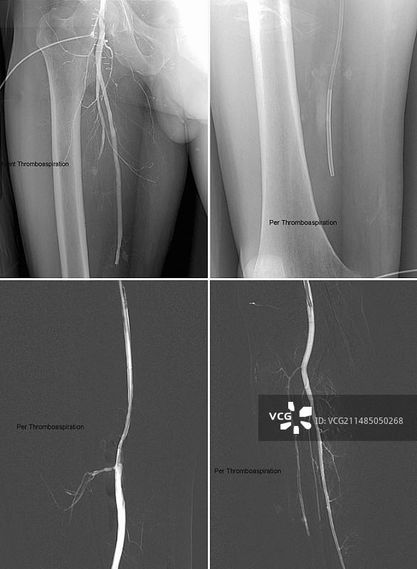 腿部血栓血管造影图片素材