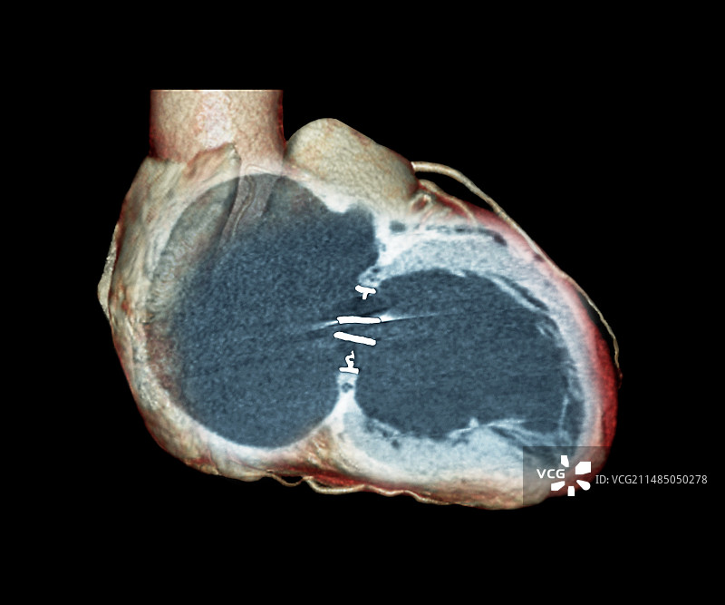 人工心脏瓣膜3D CT扫描图片素材