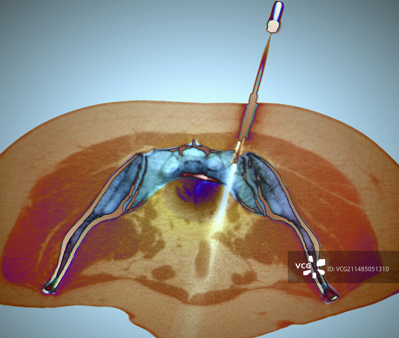 继发性骨癌治疗：CT扫描图片素材