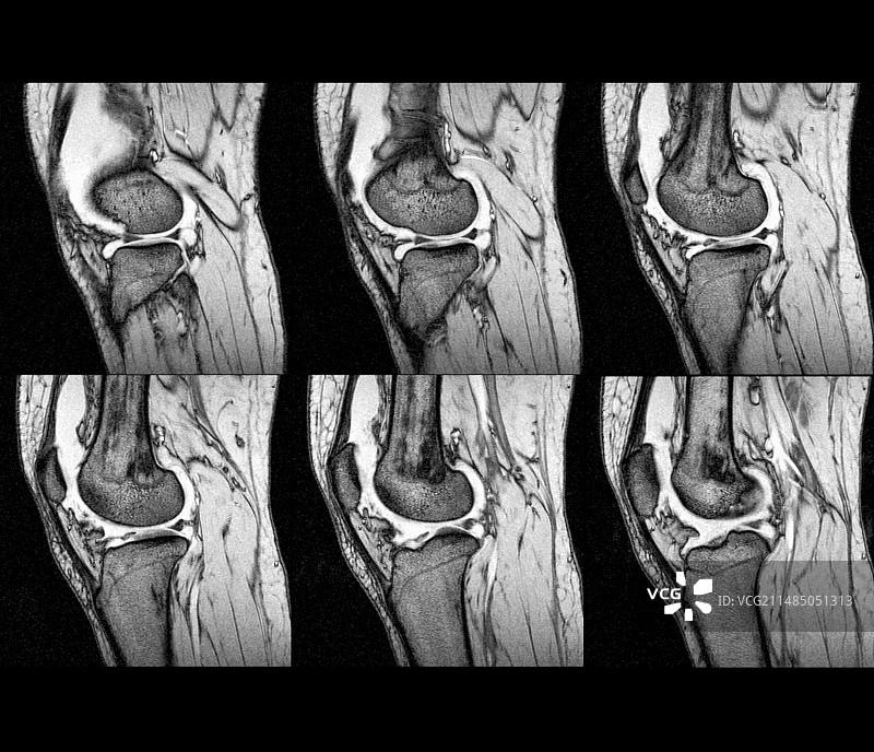 膝盖扭伤核磁共振扫描图片素材