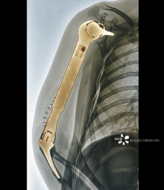 肱骨头置换术X光片图片素材