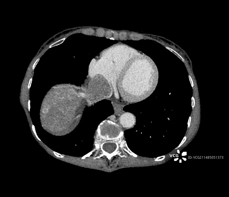 平滑肌肉癌的CT扫描图片素材