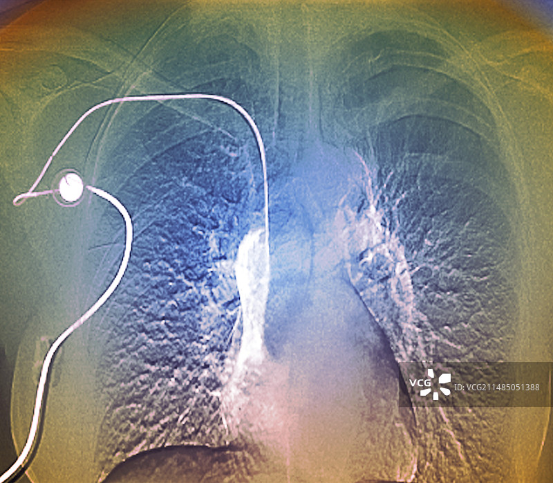 乳腺癌治疗血管造影图片素材