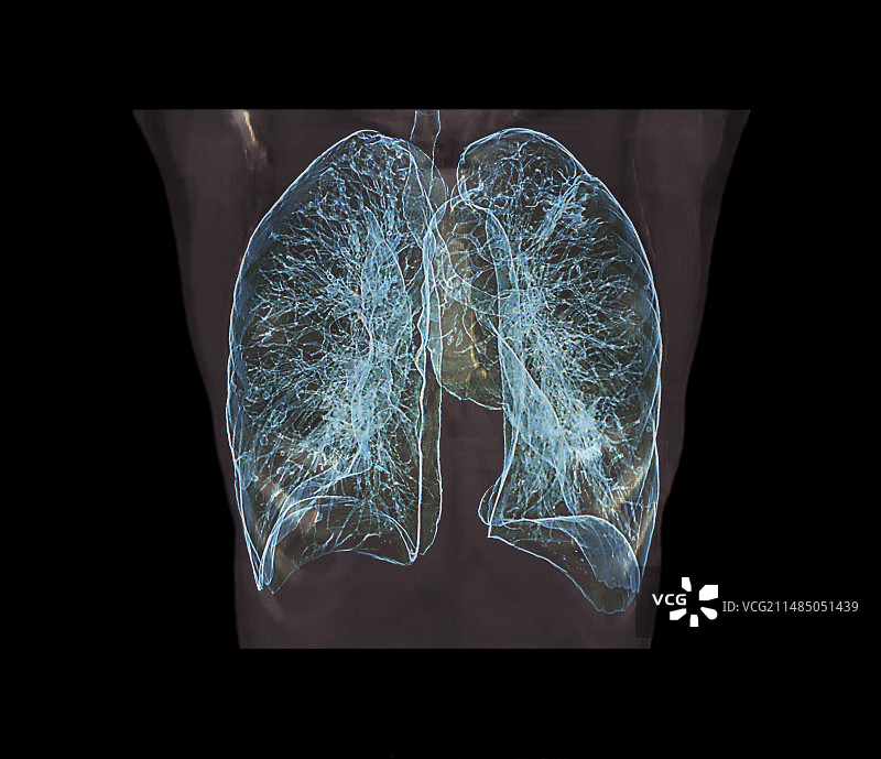 肺部3D CT扫描图片素材