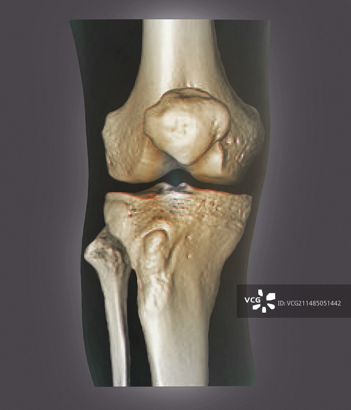 健康的膝盖3D CT扫描图片素材