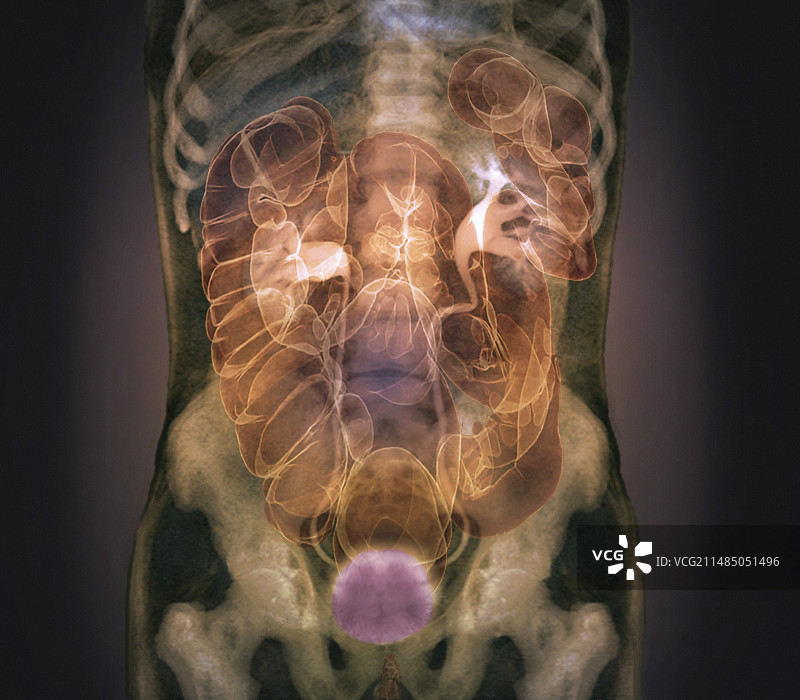 健康的腹部CT合成扫描图片素材