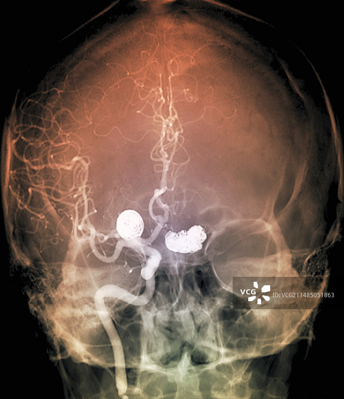 动脉瘤治疗血管造影图片素材