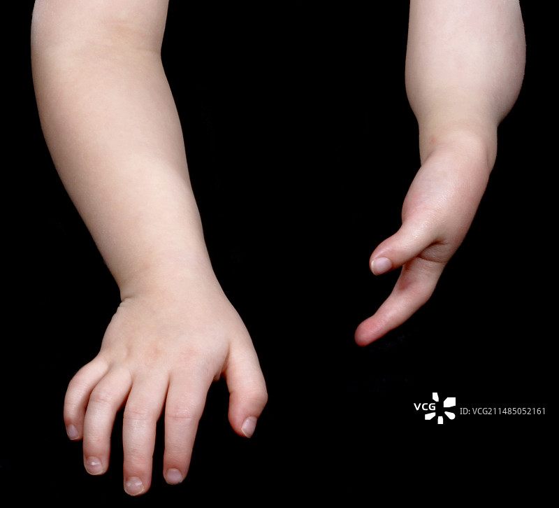 波兰综合征图片素材