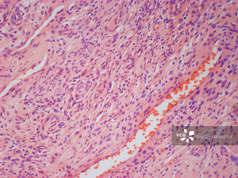 婴儿肌纤维瘤，显微照片图片素材