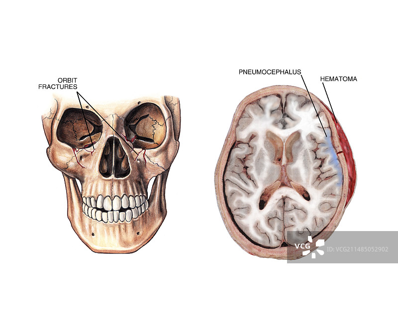面部骨折和脑损伤图片素材