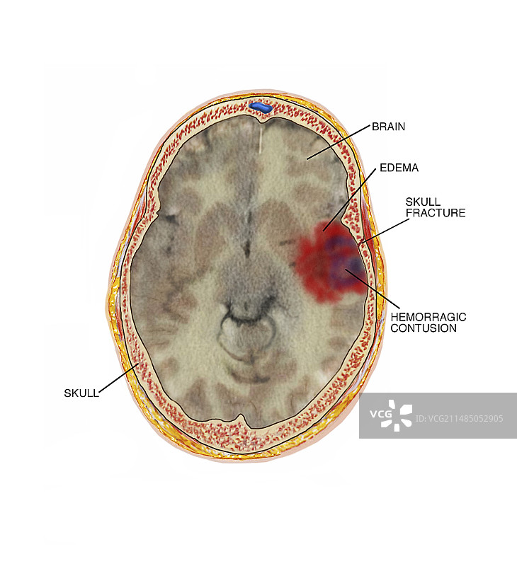 因颅骨骨折引起的脑挫伤图片素材