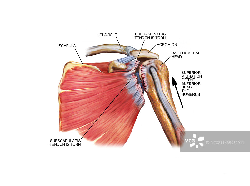 肩袖肌腱损伤图片素材