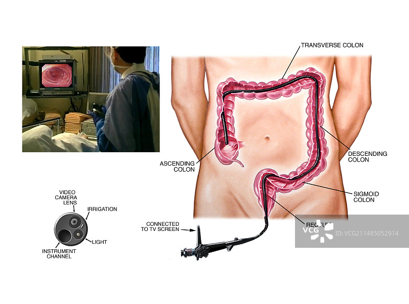 结肠镜检查程序图片素材