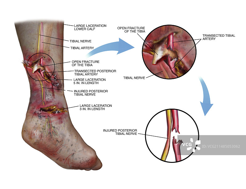 创伤性小腿和脚踝损伤图片素材