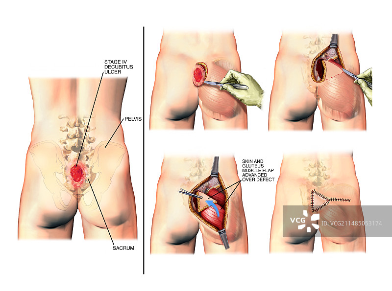 褥疮手术图片素材