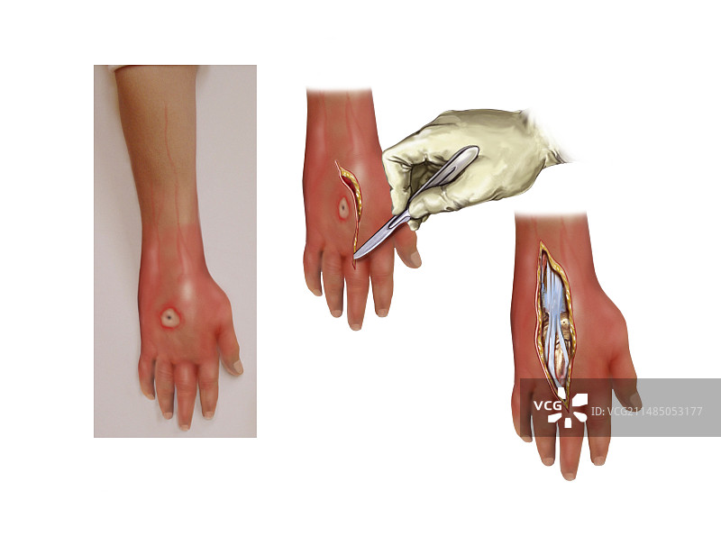 感染手部的伤口护理，艺术作品图片素材
