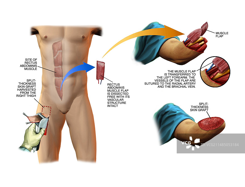 手臂残端的肌肉和皮肤移植图片素材