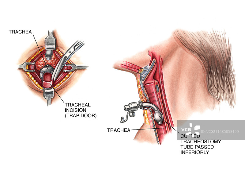 气管造口手术图片素材