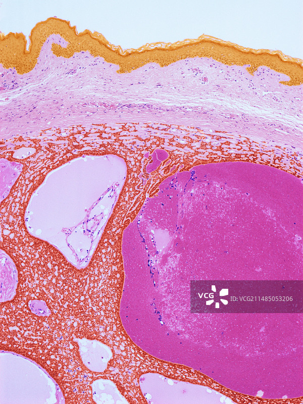 皮肤癌浅显显微照片图片素材