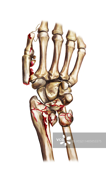 手腕和拇指骨折，艺术作品图片素材