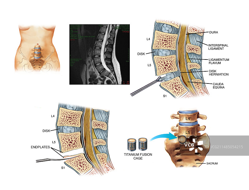 腰椎融合手术图片素材