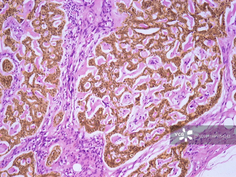 乳腺癌光学显微照片图片素材