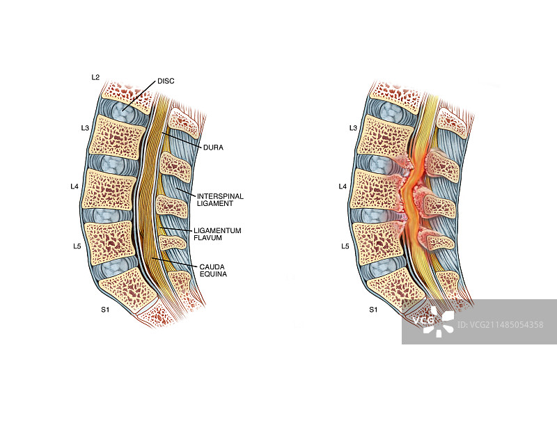 腰椎管狭窄引起的神经压迫图片素材