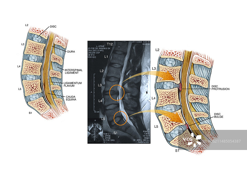 腰椎间盘突出图片素材