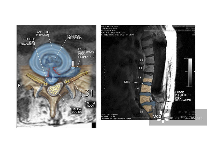 腰椎间盘滑脱图片素材