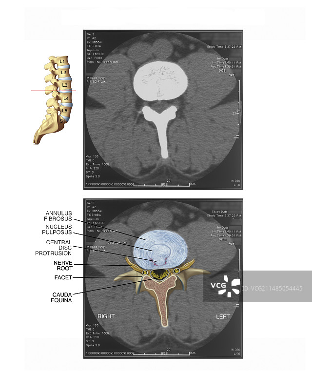 腰椎间盘突出图片素材