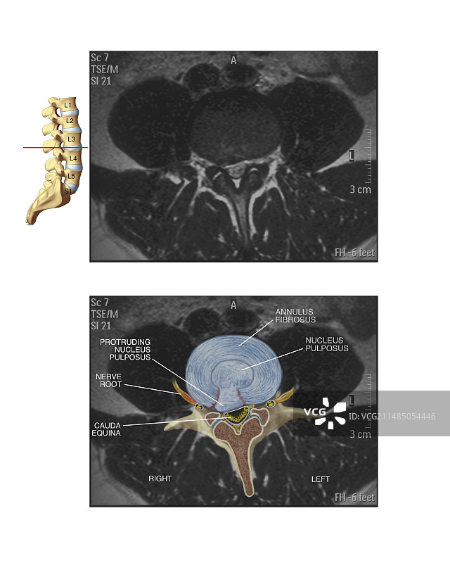 腰椎间盘滑脱图片素材