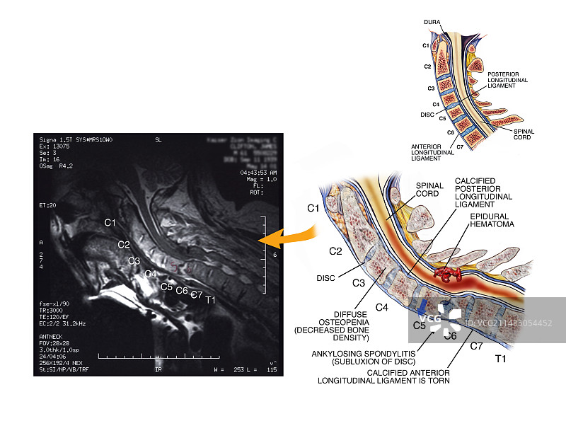 强直性脊柱炎，颈椎图片素材