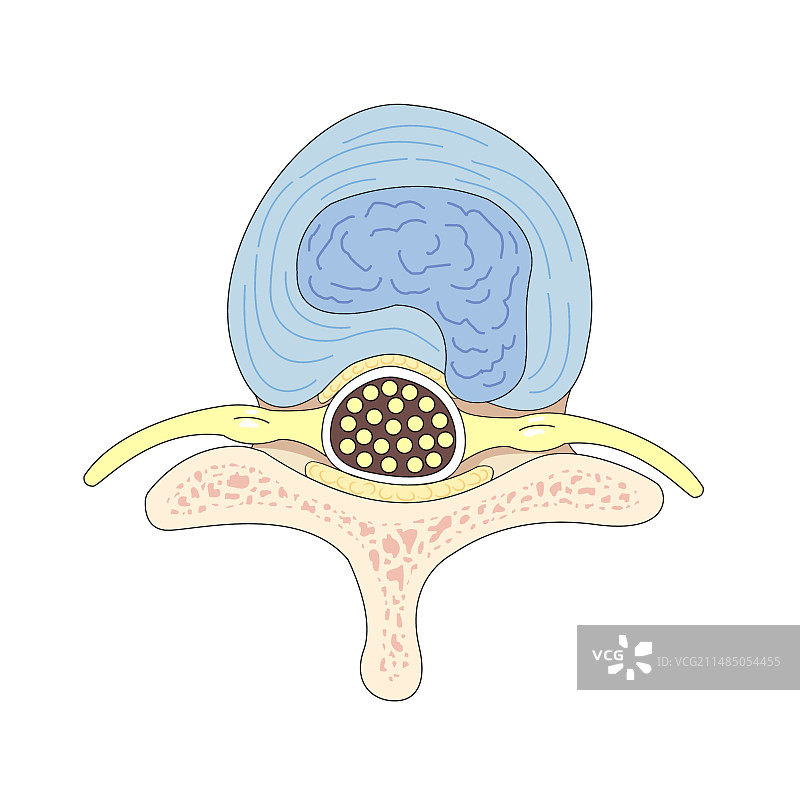 椎间盘突出图片素材