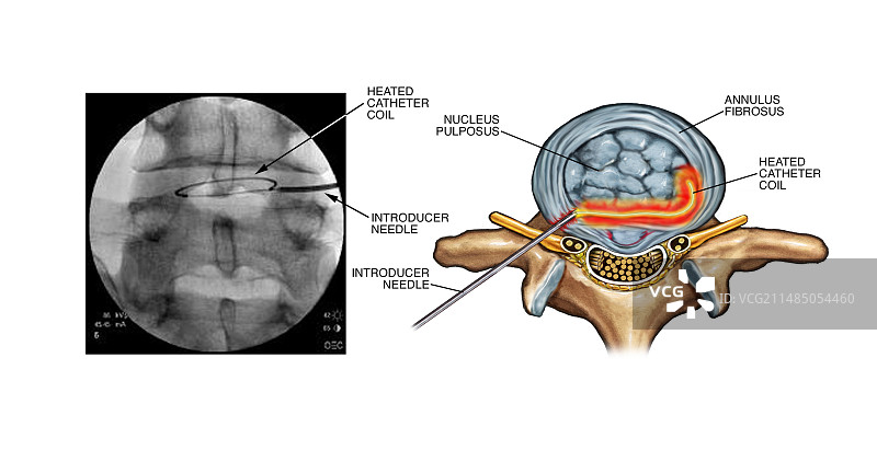 受损椎间盘的环形修复术图片素材