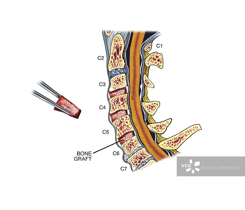 颈椎修复植骨图片素材