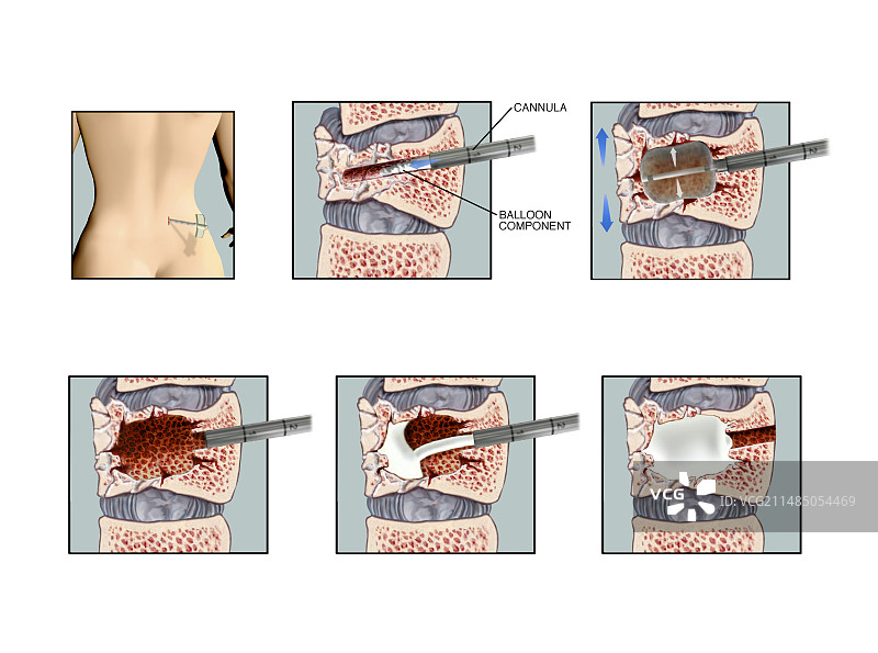 椎体骨折后凸成形术图片素材