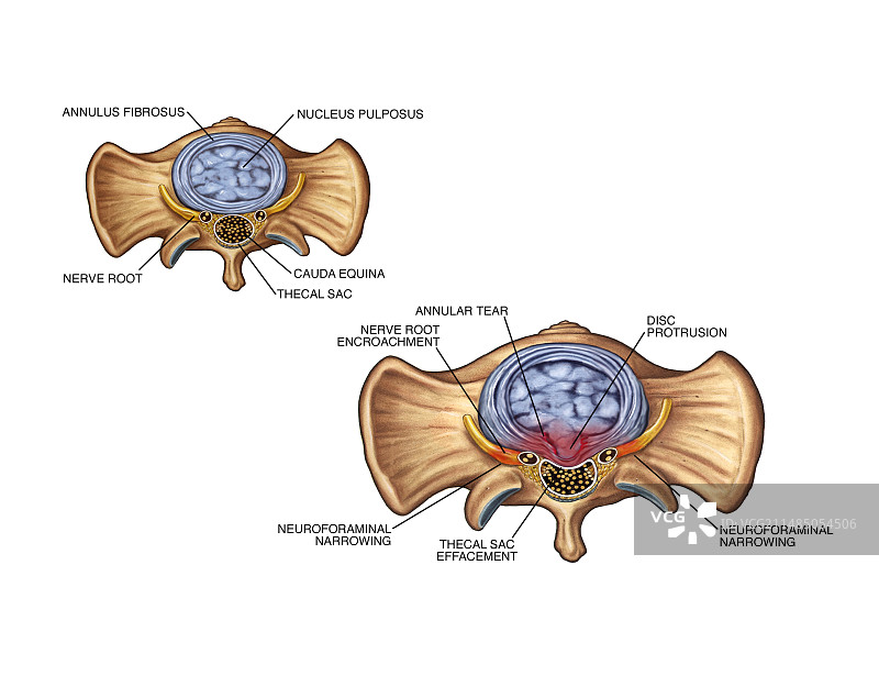 椎间盘纤维环撕裂图片素材