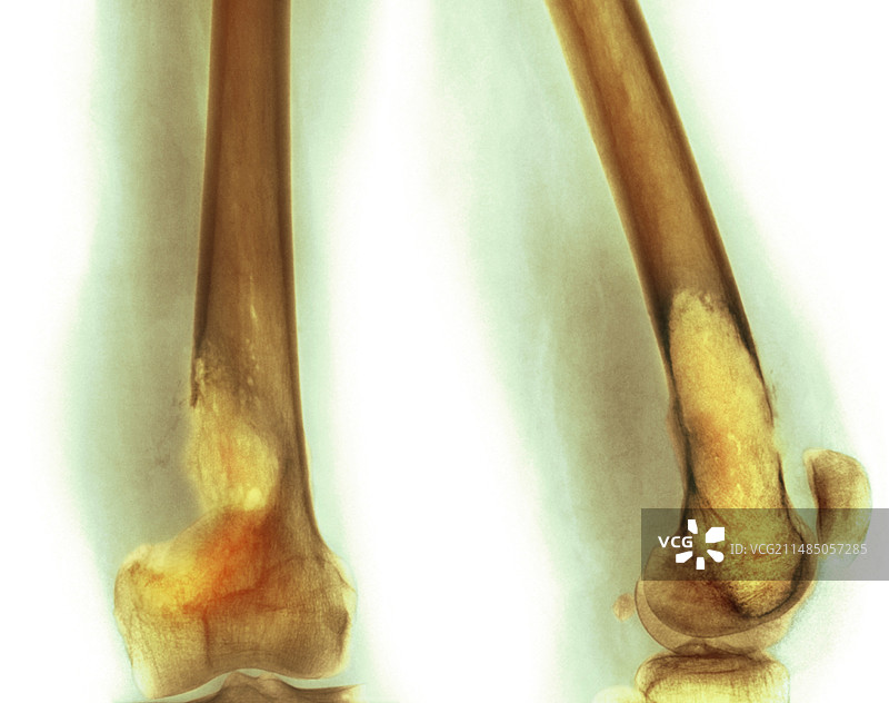 骨肿瘤X光片图片素材